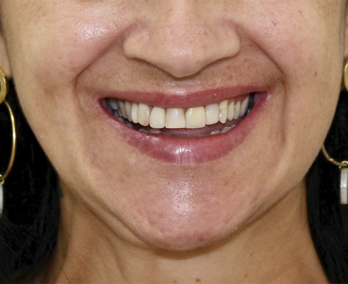 Antes das facetas dentárias — caso real de paciente do Dr. Adriano Campos Filho em Rio do Sul