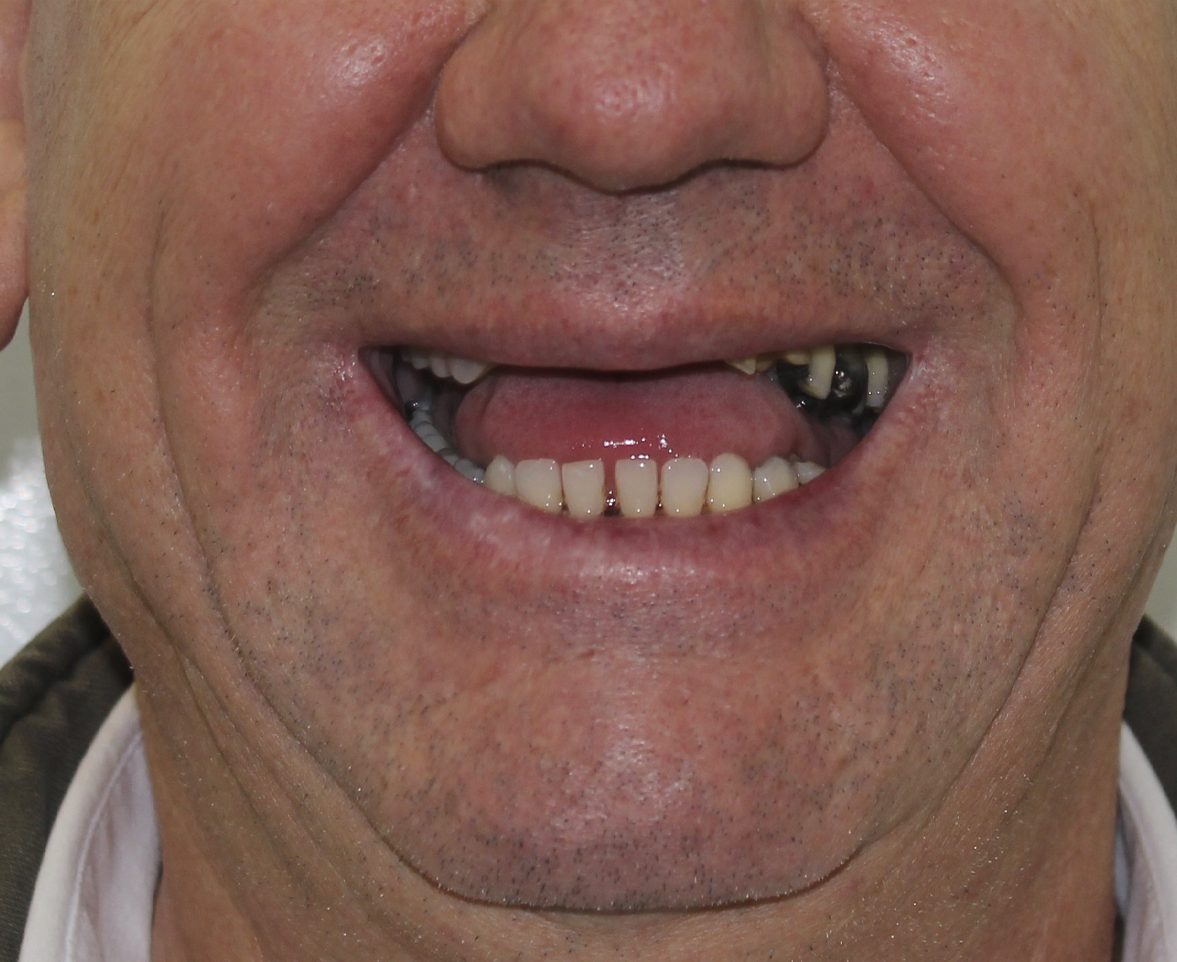 Antes do implante dentário — caso real de paciente do Dr. Adriano Campos Filho em Rio do Sul